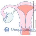 Как проходит операция по удалению матки у женщин в гинекологии?